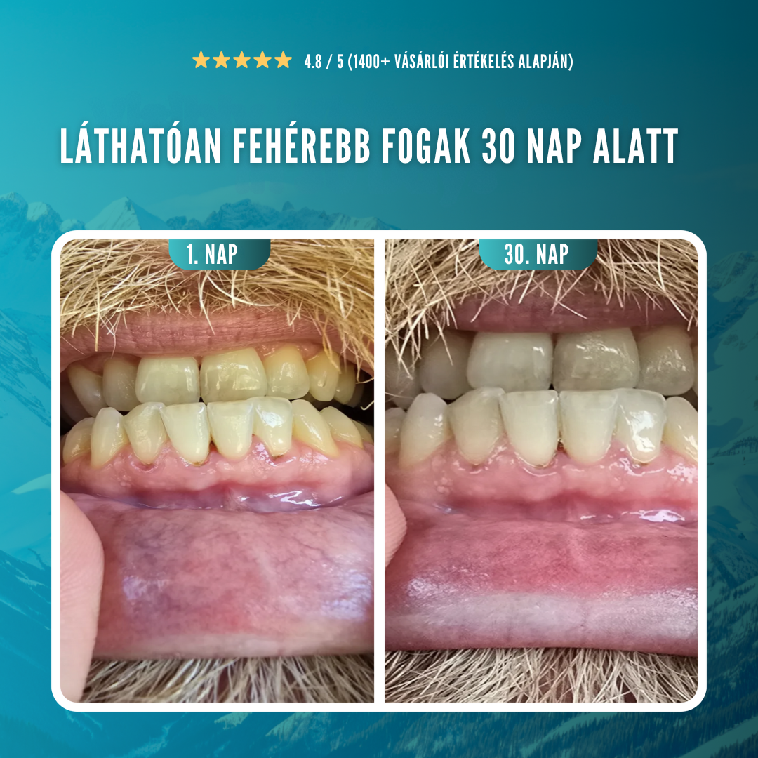 Dentora™ – Fogfehérítő rágógumi